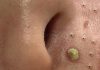 Cystic Blackheads Extraction Whiteheads