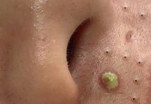 Cystic Blackheads Extraction Whiteheads