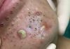 Blackheads Extraction Whiteheads