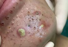 Blackheads Extraction Whiteheads