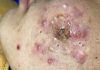 Cystic Acne Blackheads