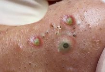 Blackheads Extraction