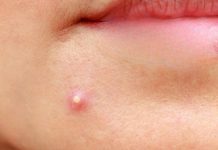 Cystic Blackheads Extraction