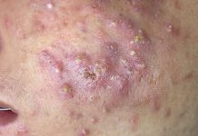 Cystic Acne Extraction Blackheads