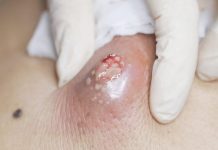 Big Cystic Blackheads Extraction