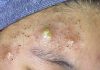 Cystic Acne Blackheads
