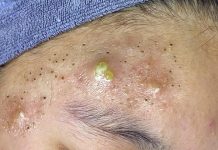 Cystic Acne Blackheads