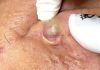 Big Cystic Blackheads Extraction