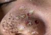 Cystic Acne Blackheads Extraction