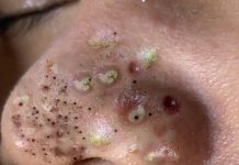 Cystic Acne Blackheads Extraction