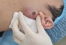Cystic Blackheads Extraction