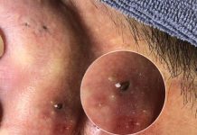 Blackheads Extraction Blackheads