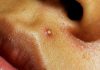 Blackheads and Whiteheads