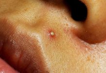 Blackheads and Whiteheads