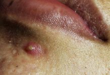 Blackheads Extraction Whiteheads