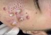 Acne Blackheads Extraction Whiteheads