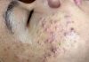 Cystic Acne Blackheads Extraction Whiteheads