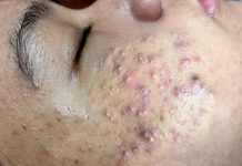 Cystic Acne Blackheads Extraction Whiteheads