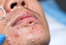 Cystic Acne Blackheads Extraction