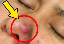 Cystic Blackheads Extraction