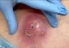 Big Cystic Blackheads Extraction