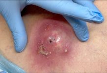 Big Cystic Blackheads Extraction