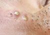 Acne Blackheads Whiteheads
