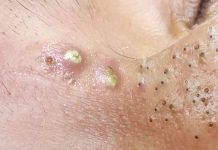 Acne Blackheads Whiteheads
