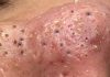 Cystic Blackheads Extraction