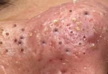 Cystic Blackheads Extraction