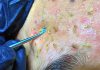 Acne Blackheads Extraction Whiteheads