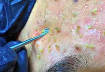 Acne Blackheads Extraction Whiteheads