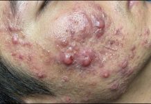 Cystic Acne Blackheads Extraction