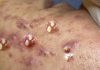 Big Cystic Acne Blackheads and Whiteheads