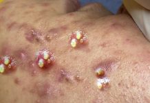 Big Cystic Acne Blackheads and Whiteheads