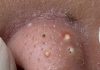 Blackheads Extraction Whiteheads