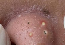 Blackheads Extraction Whiteheads