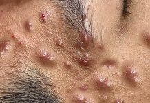 Cystic Acne Blackheads Extraction