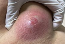 Big Cystic Blackheads Extraction