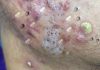 Cystic Acne Blackheads Whiteheads