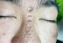 Cystic Acne Blackheads Whiteheads