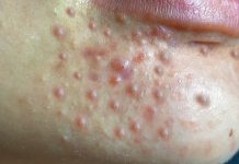 Cystic Acne Extraction Whiteheads