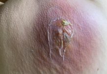 Cystic Blackheads Extraction