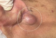 Big Cystic Blackheads