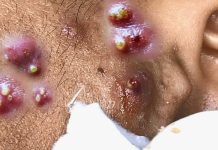 Big Cystic Blackheads Extraction