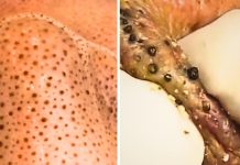 Blackheads Extraction Pimples