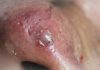 Cystic Blackheads Extraction