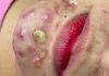 Acne Blackheads Extraction Whiteheads
