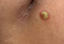 Cystic Acne Extraction Whiteheads