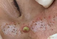 Cystic Extraction Whiteheads